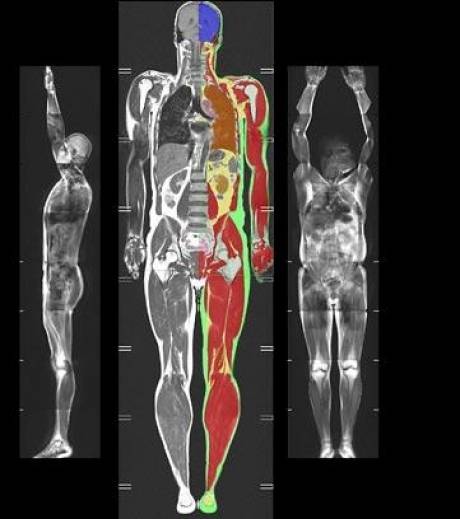 imageAthlet The abuse omega 6 and the deficit in omega 3 support obesity from generation to generation